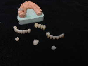 Dental Crowns & Bridges Dental Crowns & Bridges in Philadelphia PA