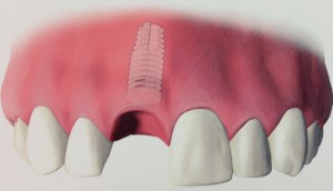 Dental Implants - Second Step Tooth Replacement Procedures in Philadelphia PA