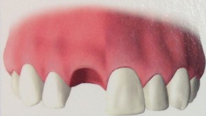 Dental Implants - First Step Dental Implants Philadelphia