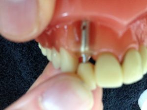 Dental Implants