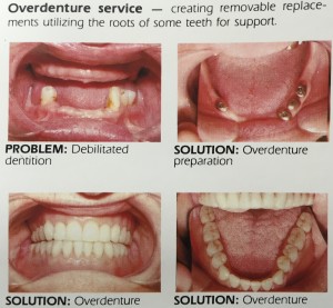 overdenture