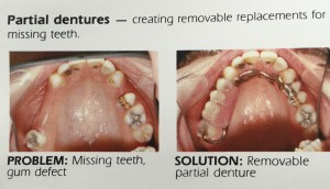 partial denture